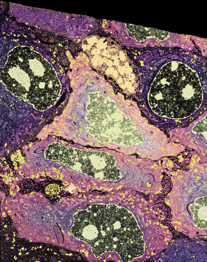 Melanoma cancer cells, TEM