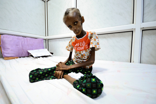 Saida Ahmad Baghili, who is affected by severe acute malnutrition, sits on a bed at the al-Thawra hospital in the Red Sea port city of Houdieda