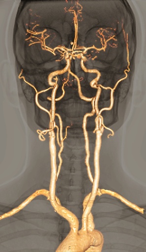 Normal arteries, 3D CT scan