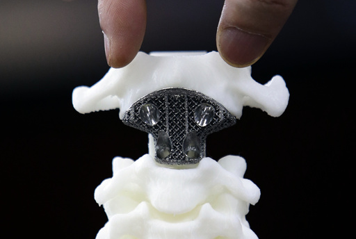 Spine model implanted with a 3D-printed artificial axis is displayed at Peking University Third Hospital in Beijing
