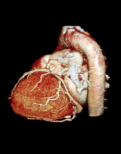 Normal heart, 3D CT scan