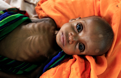 An unidentified severely malnourished Somali refugee child rests inside a ward at the Medecins Sans Frontieres (MSF) hospital at the Dagahale refugee camp in Dadaab, near the Kenya-Somalia border, in Garissa County